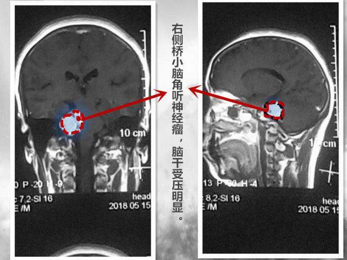 经检查,发现其为右侧桥小脑角区听神经鞘瘤.